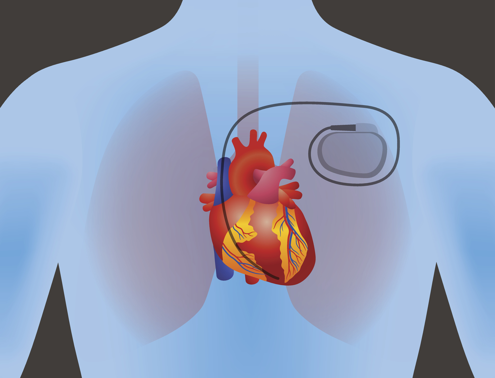 Cardiac devices Photo